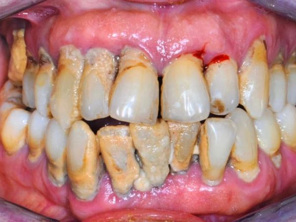 sangerarea gingiilor